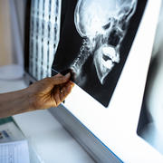 doctor holding xray of skull