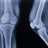 New Study by HSDM Researchers May Have Implications for Treating Osteoporosis 